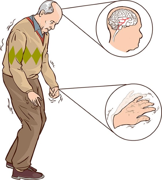 Velmi charakteristickým symptomem Parkinsonovy choroby je třes, zejména pak třes rukou, s čímž může souviset například drobný a těsný rukopis a celkově špatná pohyblivost rukou